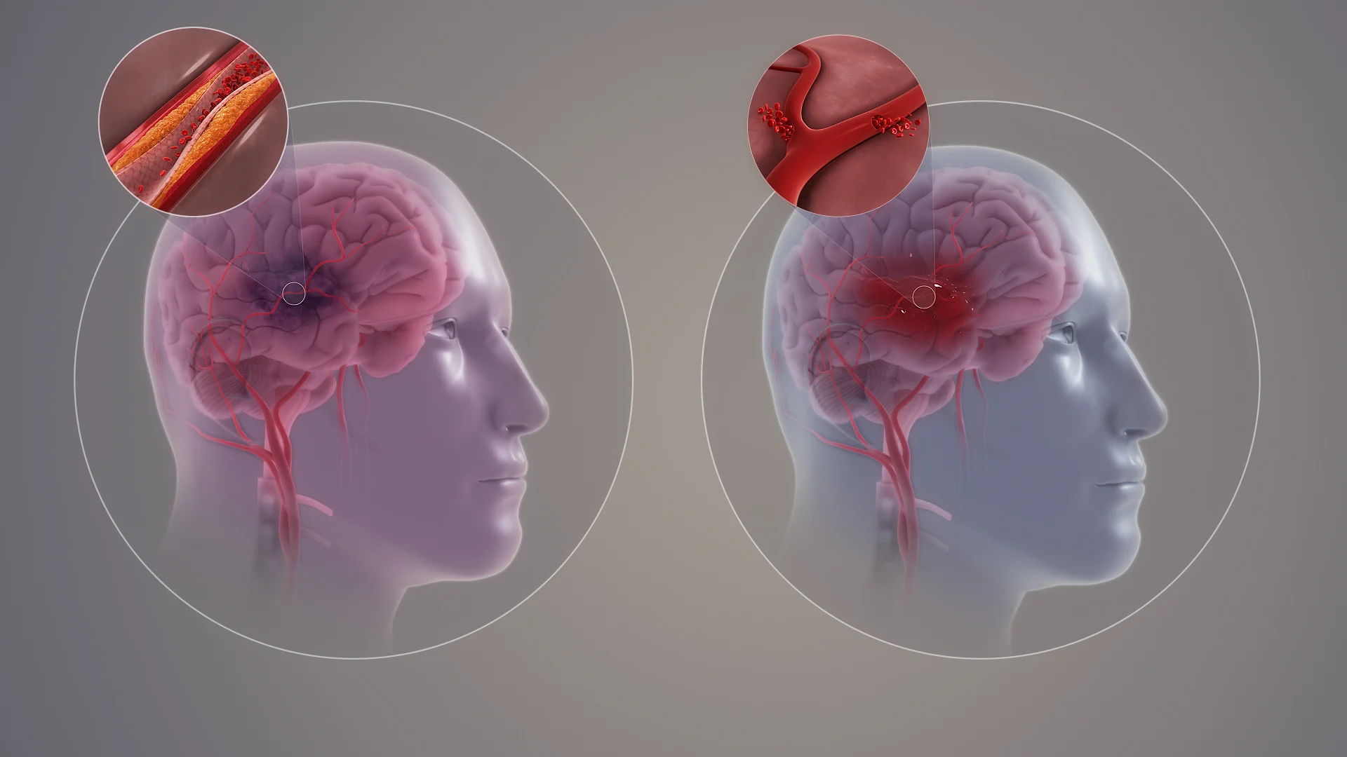 Types of Stroke